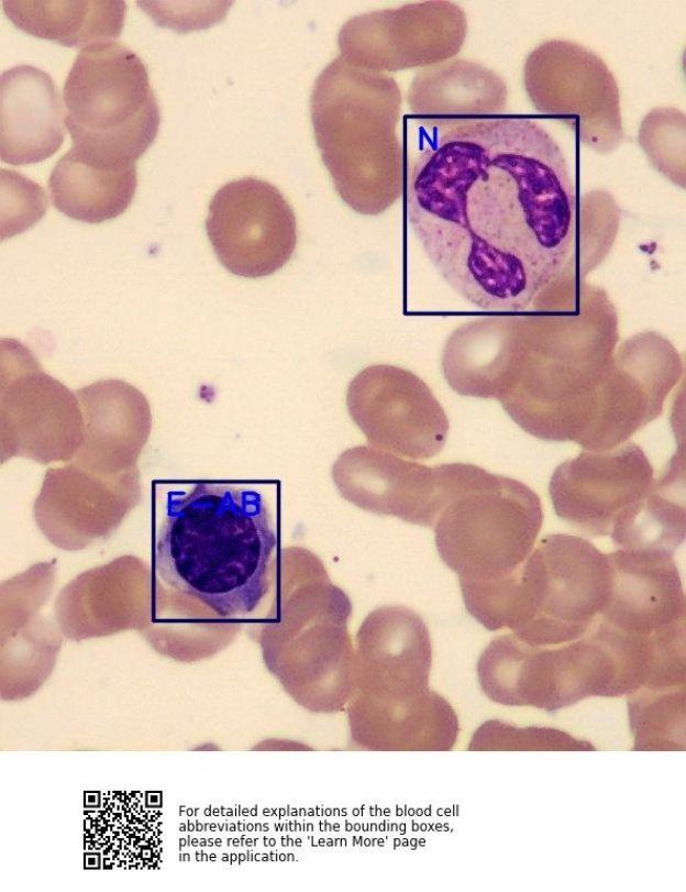 AI-Processed Bone Marrow Sample Image